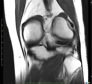 Figure 3 for case Meniscal ossicle